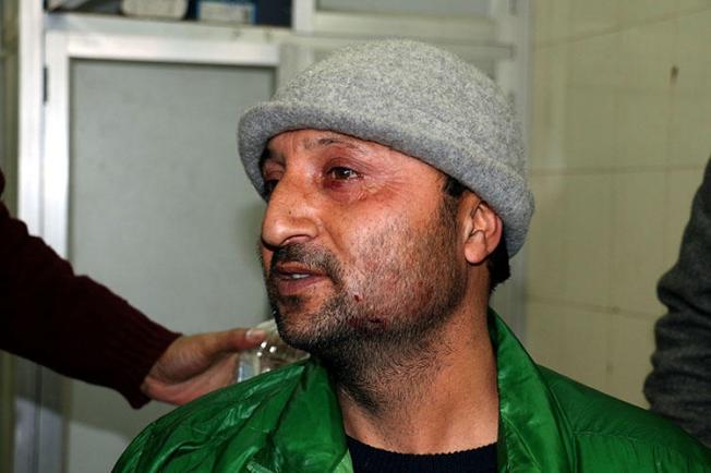 Photojournalist Nisar ul Haq, who was among four journalists injured by pellet-gun fire from Indian security forces on January 22, 2019. (Photo courtesy of Nisar ul Haq)