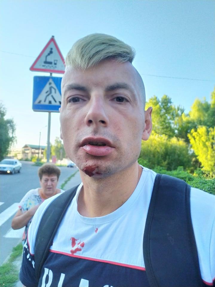 Stakh is seen following the attack. (Image via Igor Stakh)