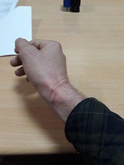 Indents are seen on the wrist of Ahmet Kanbal, after the Mezopotamya News Agency reporter was taken into custody in Izmir on February 9, 2018. (Mezopotamya News Agency/MA)