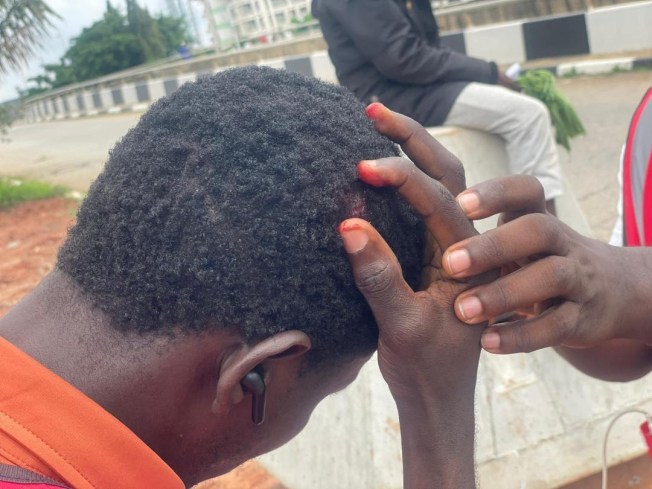 Reporter Yakubu Mohammed of Premium Times shows a head wound which he said was caused by police officers who hit him with gun butts and batons in the Nigerian capital Abuja on August 1.