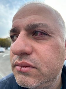 Sergi Baramidze, a camera operator for pro-opposition broadcaster Mtavari Arkhi, shows his injuries from police after he filmed a protest contesting the results of Georgia’s parliamentary election in Tbilisi on November 19, 2024. (Photo: Facebook/Mtavari Arkhi)