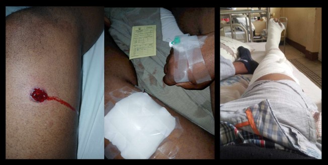 The left and center photo shows reporter Gaspar Chirinda’s injury before and after it was treated; police fired a tear gas canister that hit Chirinda’s legs on October 21, 2024. The right photo shows TV Gloria camera operator Bruno Marrengula’s leg; he was hospitalized for two days with a broken tibia after a police officer hit him with a tear gas canister. (Photos: Gaspar Chirinda, Bruno Marrengula) 