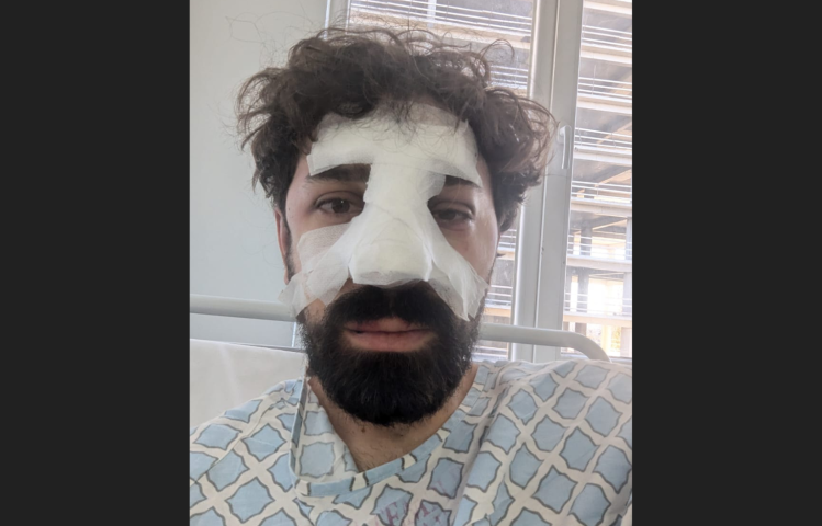 Publika reporter Aleksandre Keshelashvili suffered a broken nose following an assault by police officers before he was detained at a Tbilisi police station, among other reported incidents of journalists being assaulted while covering pro-European Union demonstrations. (Photo: Courtesy of Publika)